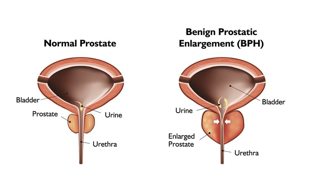 raleigh-advanced-urology-beckley-wv