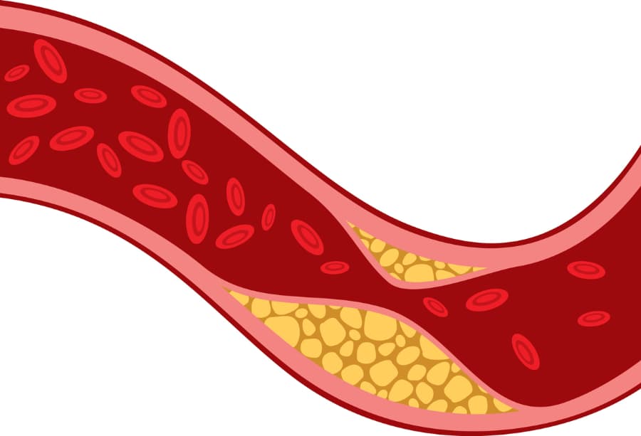 Graphic showing plaque buildup blocking artery